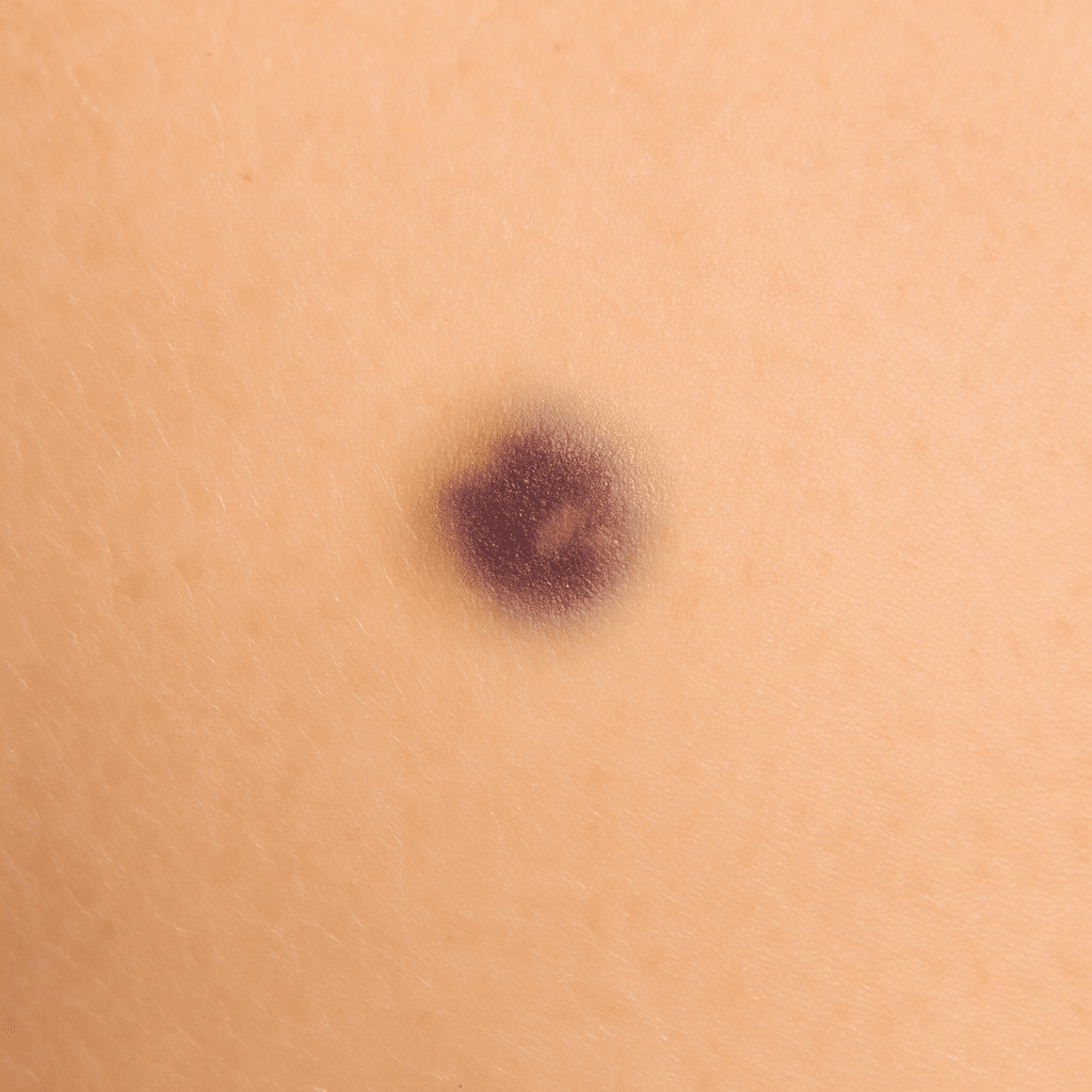 les bleus et les hématomes